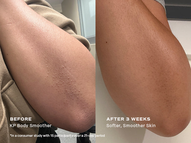 Strong on KP, Gentle on Skin